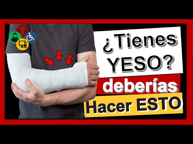 tener el brazo enyesado