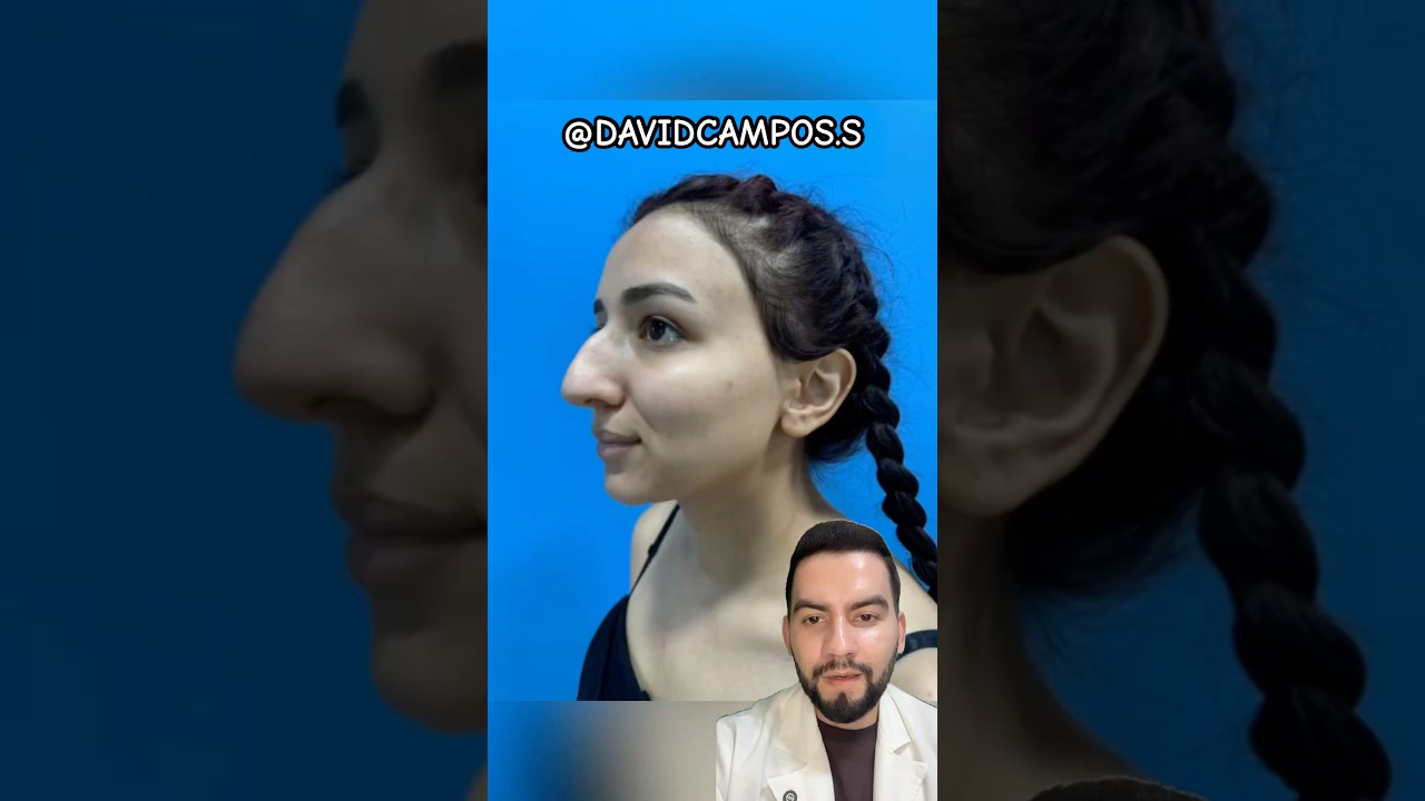 operarse la nariz un deseo de cambio o inseguridad estetica